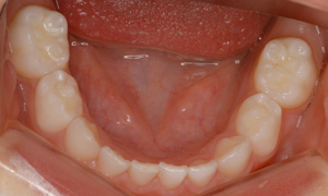 歯並びが良く、段差がないので混合歯列期に比べて虫歯になりにくい