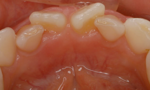 混合歯列（乳歯と永久歯が混在している）場合