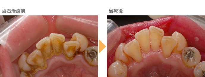 歯石治療前治療後